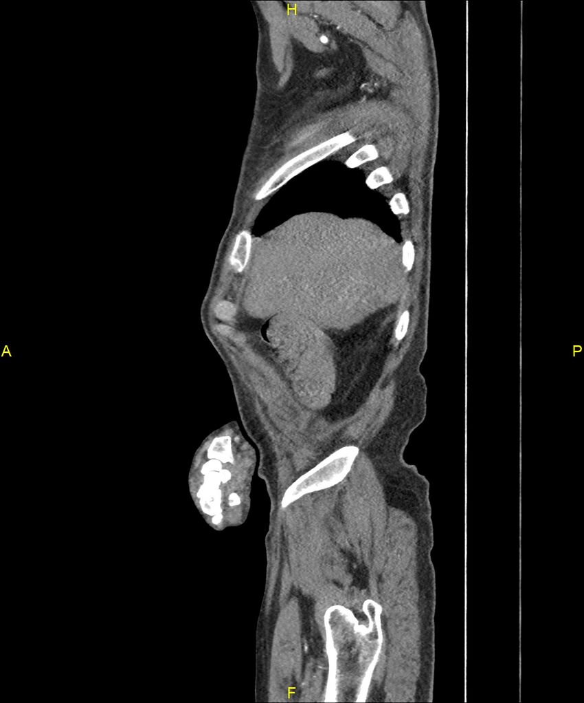 Aortoenteric fistula (Radiopaedia 84308-99603 C 41).jpg