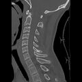 Apical pneumothorax on cervical spine CT (Radiopaedia 45343-49368 Sagittal bone window 18).jpg