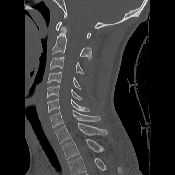 File:Apical pneumothorax on cervical spine CT (Radiopaedia 45343-49368 Sagittal bone window 18).jpg
