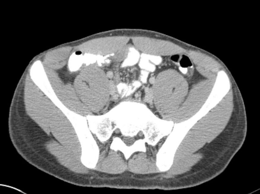 Appendicitis and incidental foregut duplication cyst (Radiopaedia 52962-58916 A 68).jpg