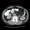 Appendicitis and renal cell carcinoma (Radiopaedia 17063-16760 A 27).jpg