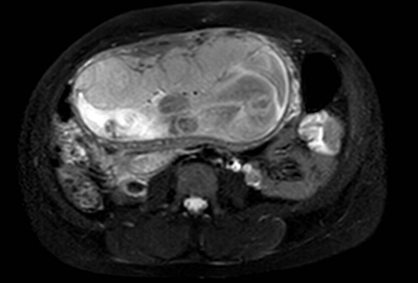 Appendicitis in gravida (MRI) (Radiopaedia 89433-106395 Axial T2 SPAIR 39).jpg