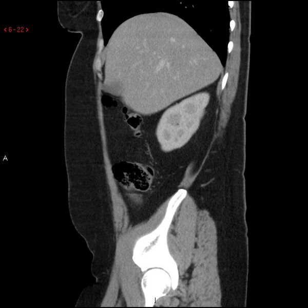 File:Appendicitis with microperforation- promontoric type (Radiopaedia 27268-27442 A 7).jpg