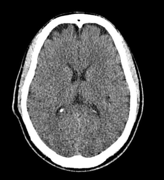 File:Arachnoid cyst of the ambient cistern (Radiopaedia 81301-94986 Axial non-contrast 41).jpg