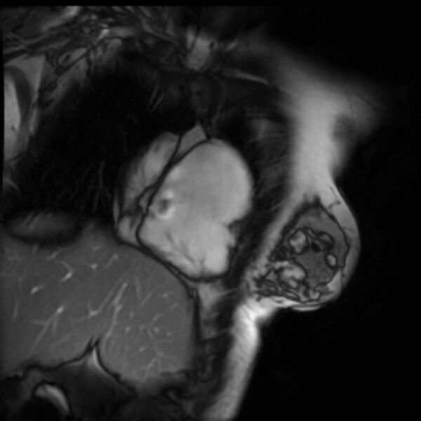 File:Arrhythmogenic right ventricular cardiomyopathy (Radiopaedia 87505-103850 2ch (RV) Cine SSFP 44).jpg