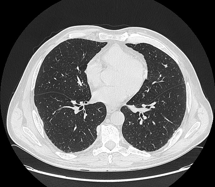 File:Asbestos pleural placques (Radiopaedia 57905-64872 Axial lung window 144).jpg