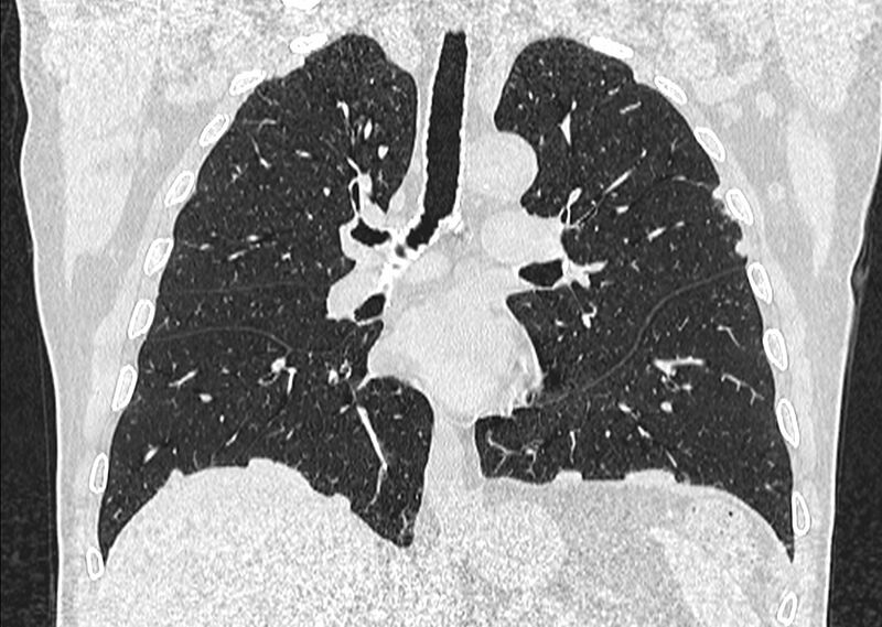 File:Asbestos pleural placques (Radiopaedia 57905-64872 Coronal lung window 151).jpg