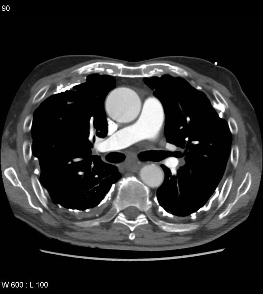 File:Asbestos related lung and pleural disease (Radiopaedia 14377-14301 D 26).jpg