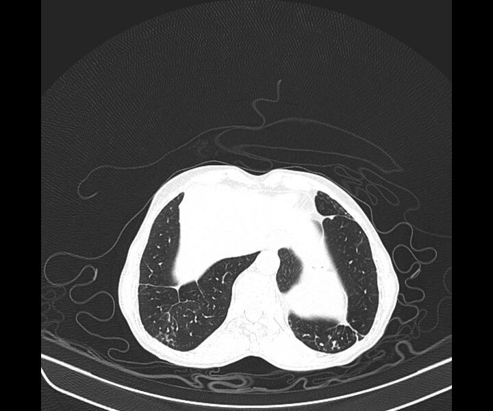 File:Aspergillomas (Radiopaedia 66779-76110 Axial lung window 42).jpg