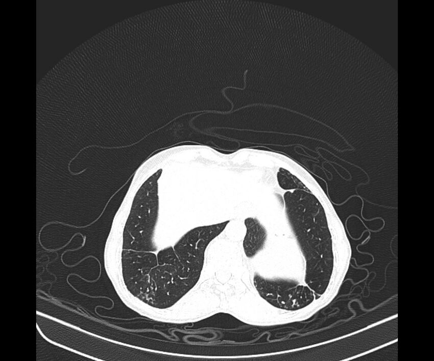 Aspergillomas (Radiopaedia 66779-76110 Axial lung window 42).jpg