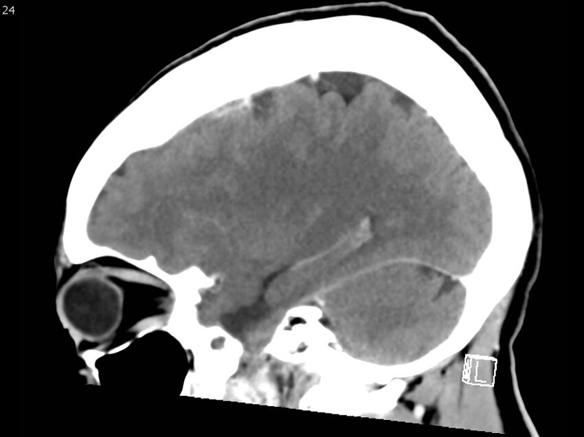 Atypical meningioma - intraosseous (Radiopaedia 64915-73867 F 23).jpg