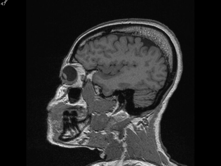 Atypical meningioma - intraosseous (Radiopaedia 64915-74572 Sagittal T1 47).jpg