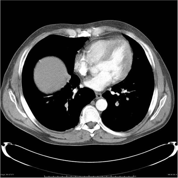 File:Atypical pneumonia - Q fever (Radiopaedia 21993-21989 C+ arterial phase 31).jpg