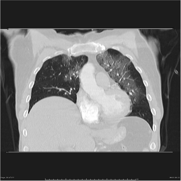 File:Atypical pneumonia - Q fever (Radiopaedia 21993-21989 C 13).jpg