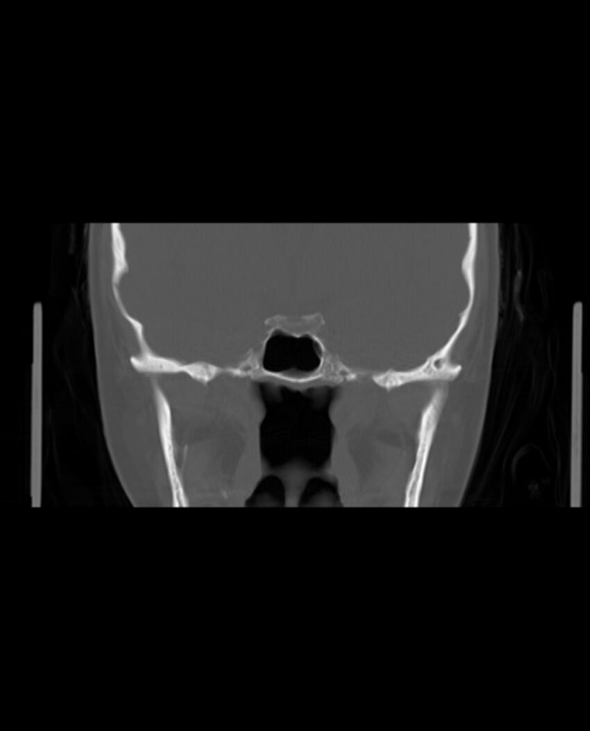 Automastoidectomy with labyrinthine fistula (Radiopaedia 84143-99411 Coronal non-contrast 75).jpg