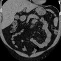 Autosomal dominant polycystic kidney disease (Radiopaedia 36539-38101 Coronal non-contrast 2).jpg