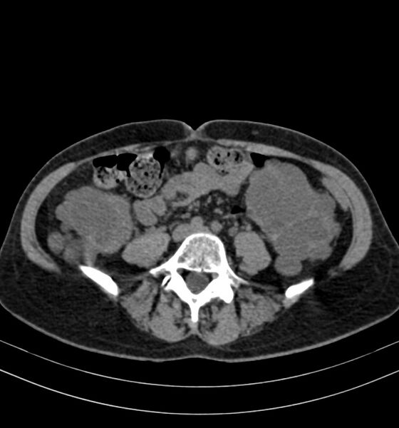 File:Autosomal dominant polycystic kidney disease (Radiopaedia 41918-44922 Axial non-contrast 21).jpg