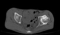 Avascular necrosis of the left hip (Radiopaedia 75068-86125 Axial bone window 28).jpg