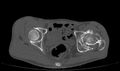 Avascular necrosis of the left hip (Radiopaedia 75068-86125 Axial bone window 45).jpg