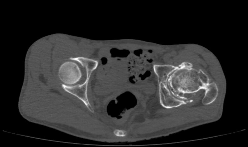 File:Avascular necrosis of the left hip (Radiopaedia 75068-86125 Axial bone window 45).jpg