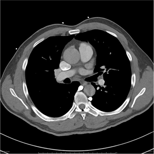 File:Azygos venous system anatomy (CT pulmonary angiography) (Radiopaedia 25928-26077 Axial C+ CTPA 41).jpg