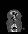 Base of skull fracture with bilateral Le Fort fractures (Radiopaedia 47094-51638 Coronal bone window 88).jpg
