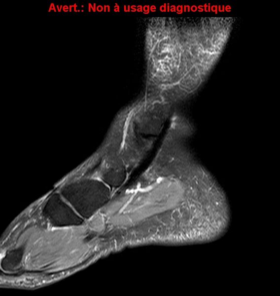 File:Baxter neuropathy (Radiopaedia 25988-26124 Sagittal T2 fat sat 5).jpg