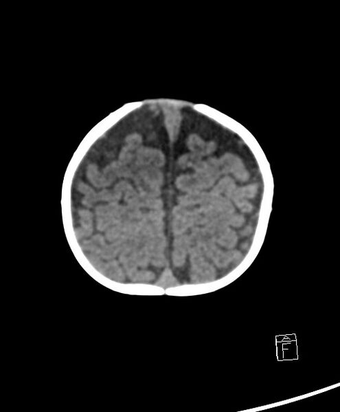 File:Benign enlargement of subarachnoid spaces in infancy (BESS) (Radiopaedia 87459-103795 Axial non-contrast 14).jpg