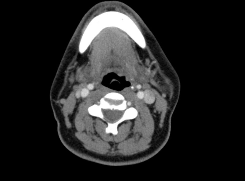 File:Benign mixed salivary tumor of the parotid gland (Radiopaedia 35261-36792 A 27).jpg
