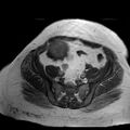 Benign seromucinous cystadenoma of the ovary (Radiopaedia 71065-81300 Axial T1 13).jpg