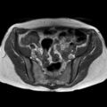 Bicornuate uterus (Radiopaedia 61974-70046 Axial T1 21).jpg
