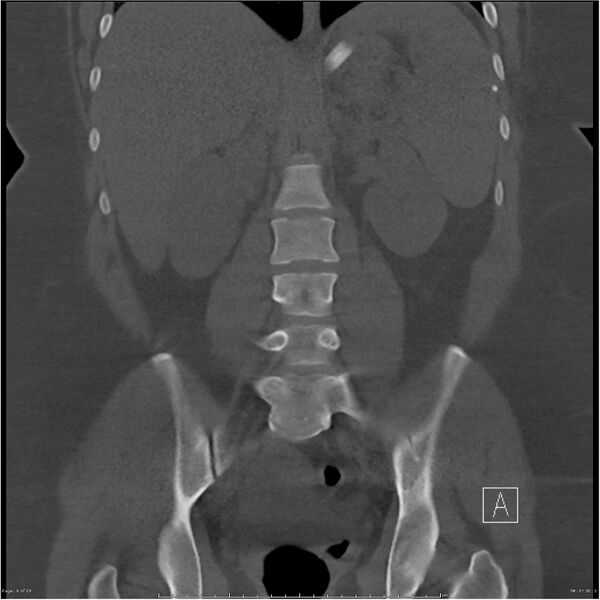 File:Bilateral lumbar ribs (Radiopaedia 25862-26010 Coronal bone window 9).jpg