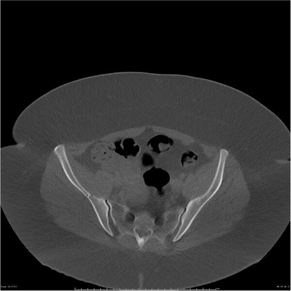 File:Bilateral lumbar ribs (Radiopaedia 25862-26010 bone window 50).jpg