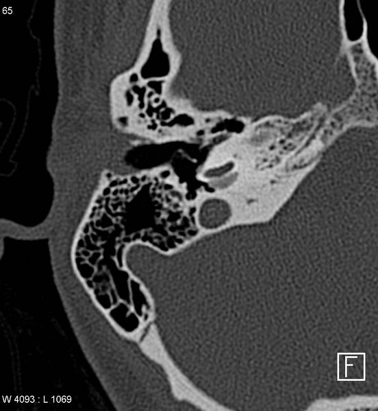 File:Bilateral otosclerosis with left stapes prosthesis (Radiopaedia 5567-7302 Axial bone window 2).jpg