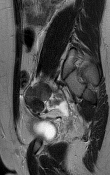 File:Bilateral ovarian fibrothecomas - adolescent (Radiopaedia 86604-102707 Sagittal T2 25).jpg