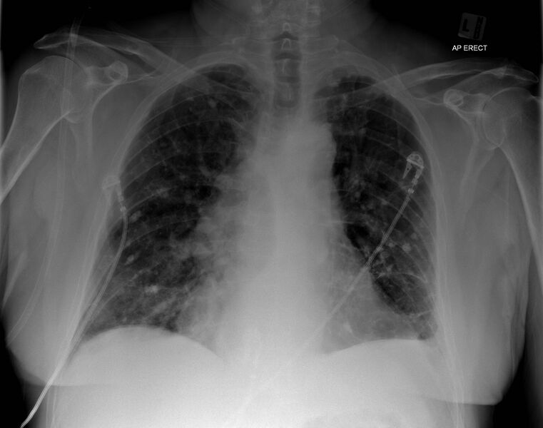 File:Bilateral pulmonary nodules - tuberculous granulomas (Radiopaedia 51543).jpg