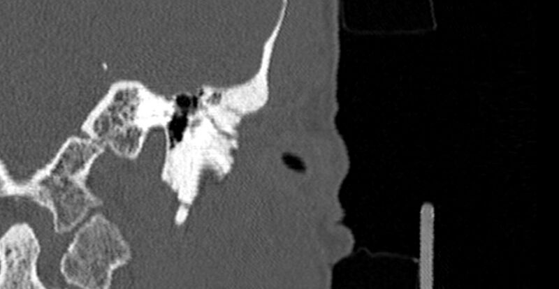 File:Bilateral temporal bone fractures (Radiopaedia 29482-29970 B 11).jpg