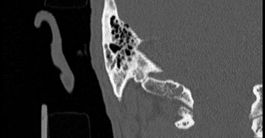 Bilateral temporal bone fractures (Radiopaedia 29482-29970 Coronal non-contrast 162).jpg