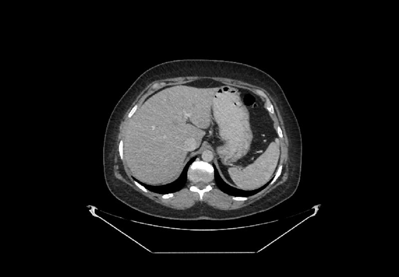 File:Bilateral urolithiasis with incidentally detected splenic artery aneurysm and left inferior vena cava (Radiopaedia 44467-48127 B 1).jpg