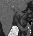 Bile leak from accessory duct(s) of Luschka post cholecystectomy (Radiopaedia 40736-43389 B 37).jpg