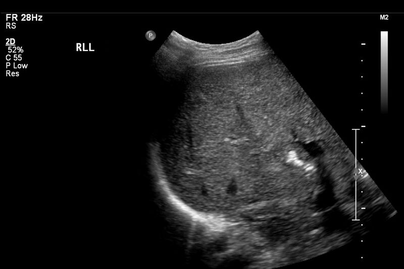 File:Biliary necrosis - liver transplant (Radiopaedia 21876-21843 A 2).jpg