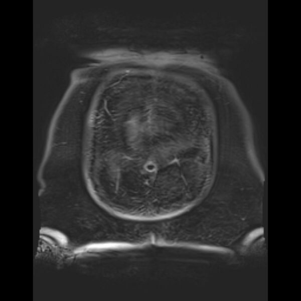 File:Bilobed placenta accreta (Radiopaedia 69648-79591 Coronal T1 vibe 2).jpg