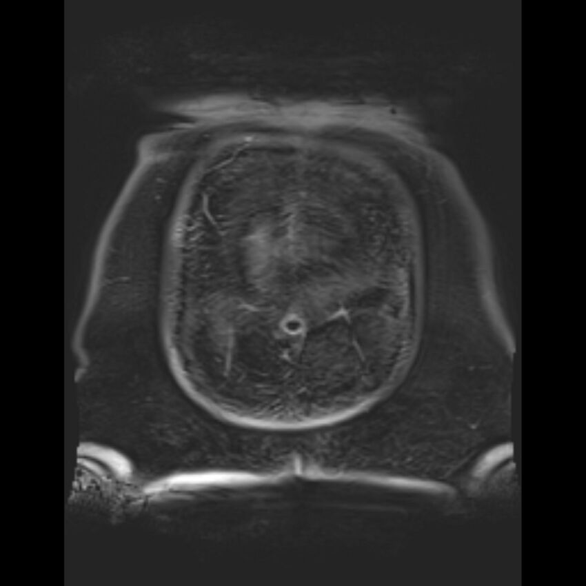 Bilobed placenta accreta (Radiopaedia 69648-79591 Coronal T1 vibe 2).jpg