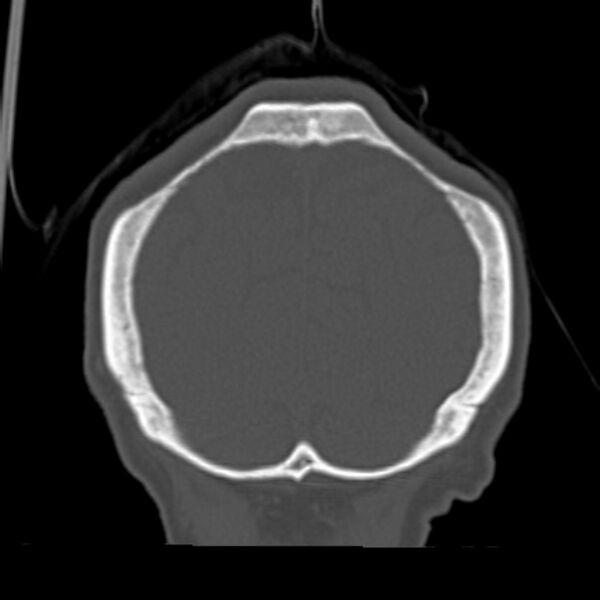 File:Biparietal osteodystrophy (Radiopaedia 46109-50463 Coronal bone window 91).jpg