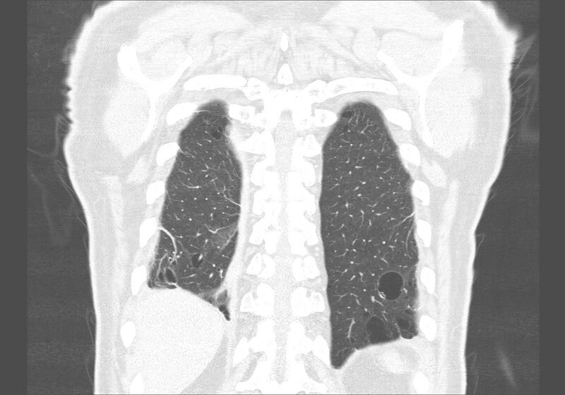 File:Birt-Hogg-Dubé syndrome (Radiopaedia 52578-58491 Coronal lung window 55).jpg