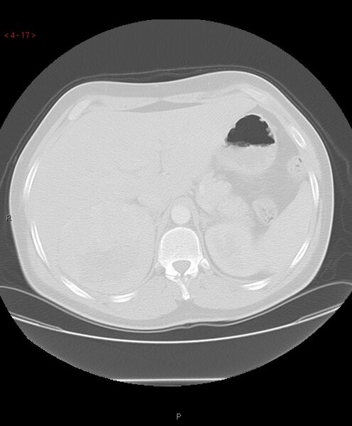 File:Birt-Hogg-Dubé syndrome (Radiopaedia 53814-60013 Axial lung window 17).jpg