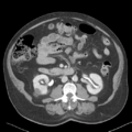 Bladder papillary urothelial carcinoma (Radiopaedia 48119-52951 Axial 24).png