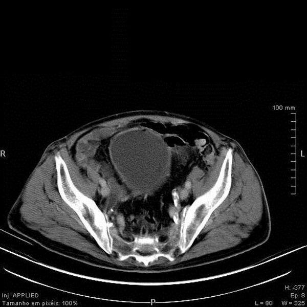 File:Bladder squamous cell carcinoma (Radiopaedia 14130-13984 B 4).jpg