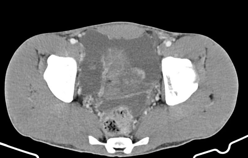 File:Blunt injury to the small bowel (Radiopaedia 74953-85987 A 172).jpg