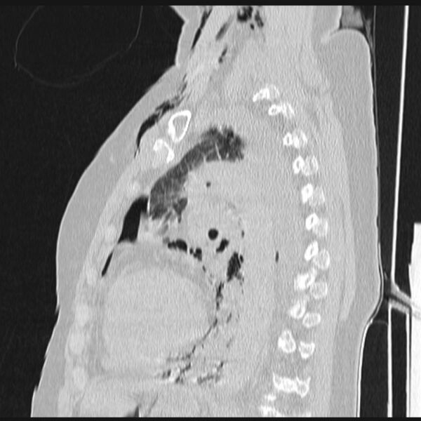 File:Boerhaave syndrome (Radiopaedia 45644-49799 Sagittal lung window 52).jpg